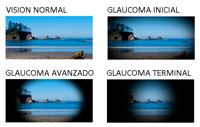 Glaucoma-1